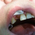 Brakująca korona zęba 12