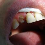 Umocowanie wkładu everStick w kanale zęba