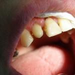 Warstwowa odbudowa zęba 12