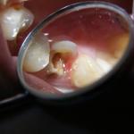 Znacznie uszkodzona korona zęba 14